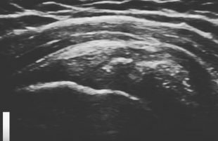 Θεραπεία με κρουστικό υπέρηχο (shockwave therapy) σε ασβεστοποιό τενοντίτιδα ώμου.